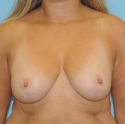 Berlet Plastic Surgery breast lift after — Cedar Grove, NJ