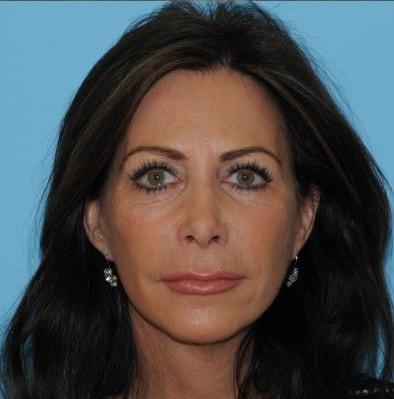 Berlet Plastic Surgery facelift after — Cedar Grove, NJ