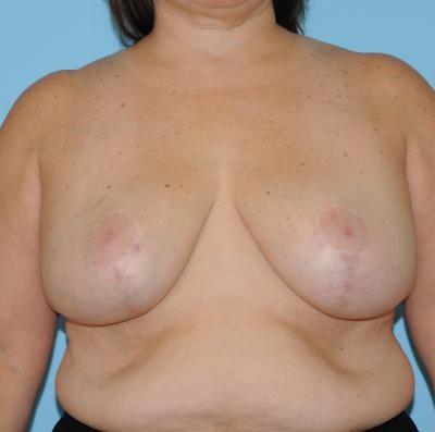 Berlet Plastic Surgery breast lift after — Cedar Grove, NJ