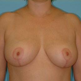 Berlet Plastic Surgery breast lift after — Cedar Grove, NJ