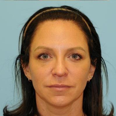 Berlet Plastic Surgery fat transfer after — Cedar Grove, NJ