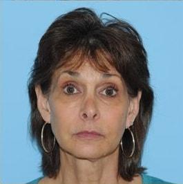 Berlet Plastic Surgery fat transfer after — Cedar Grove, NJ