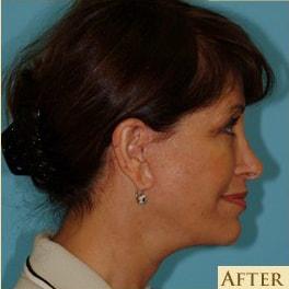Berlet Plastic Surgery facelift after — Cedar Grove, NJ