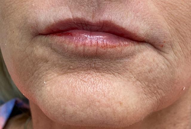 Lip Filler after at Grace and Glam Medical Spa in Cincinnati, OH