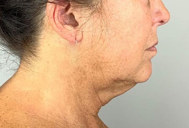 Neck Lift before at Grace and Glam Medical Spa in Cincinnati, OH