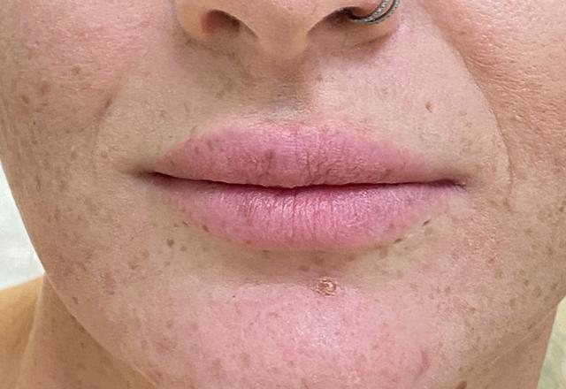 Juvederm before at Grace and Glam Medical Spa in Cincinnati, OH