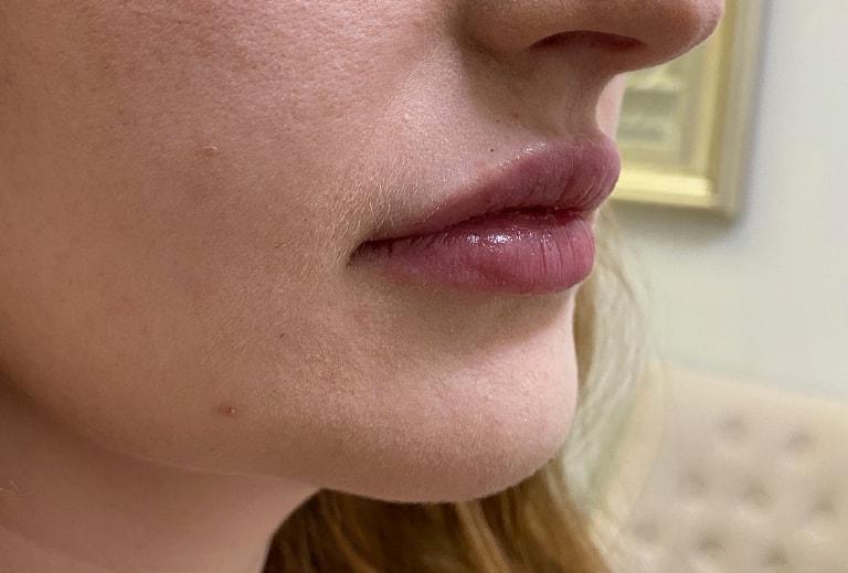 Grace and Glam Medical Spa lip filler after — Cincinnati, OH