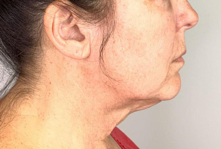 Grace and Glam Medical Spa after — Cincinnati, OH