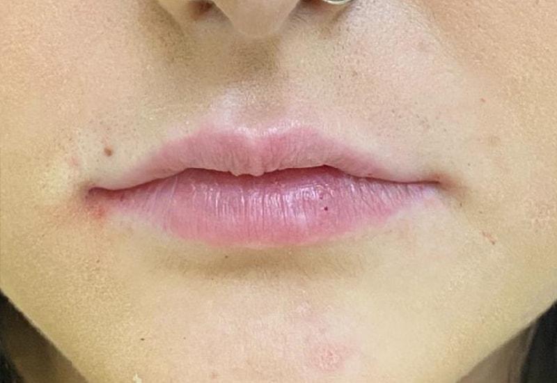 Grace and Glam Medical Spa lip filler after — Cincinnati, OH