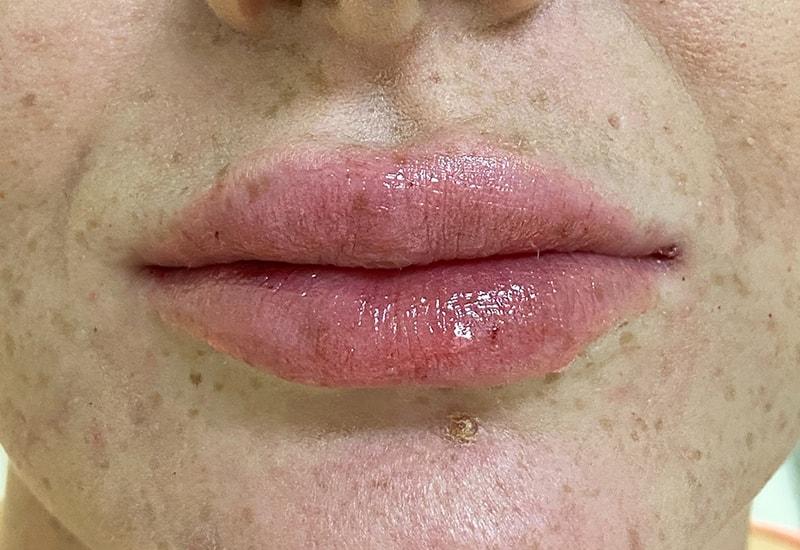 Grace and Glam Medical Spa lip filler after — Cincinnati, OH