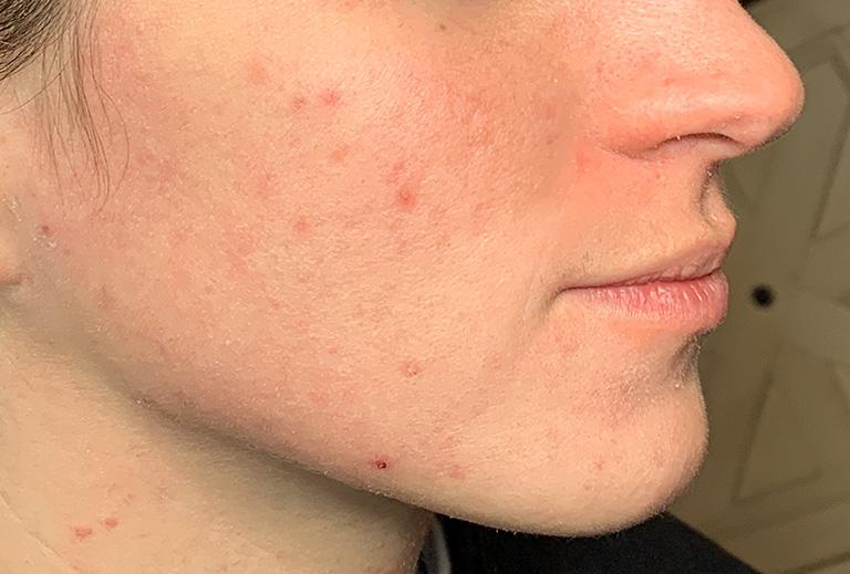 Grace and Glam Medical Spa after — Cincinnati, OH