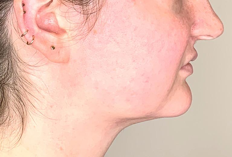 Grace and Glam Medical Spa after — Cincinnati, OH