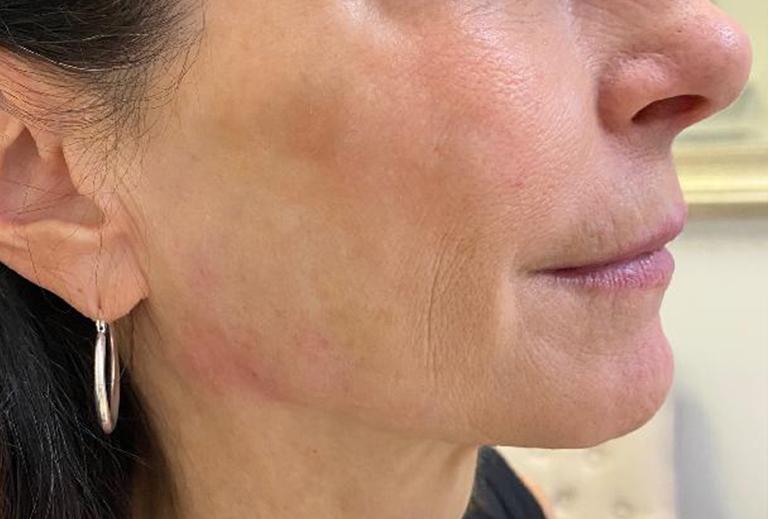 Grace and Glam Medical Spa after — Cincinnati, OH