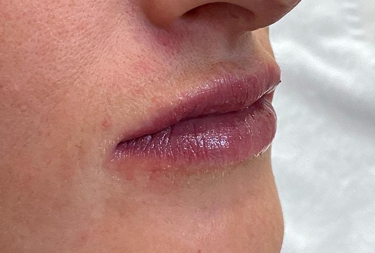 Grace and Glam Medical Spa lip filler after — Cincinnati, OH