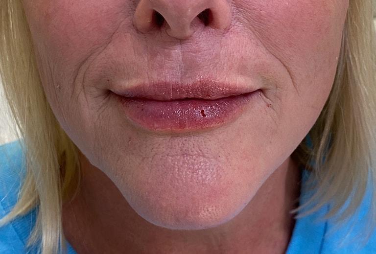 Grace and Glam Medical Spa lip filler after — Cincinnati, OH