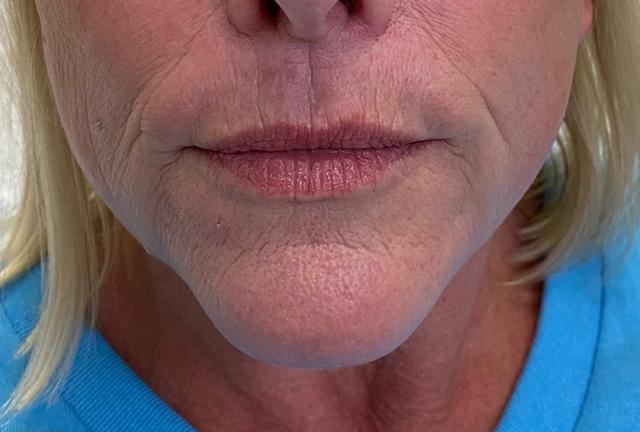 Lip Filler before at Grace and Glam Medical Spa in Cincinnati, OH