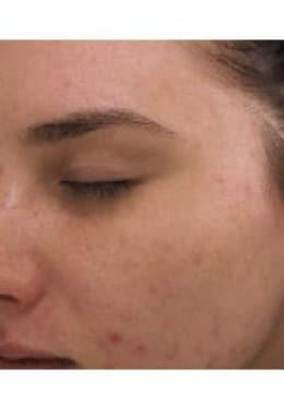 Chemical Peel after at Saltz Plastic Surgery & Saltz Spa Vitoria in Salt Lake City, UT