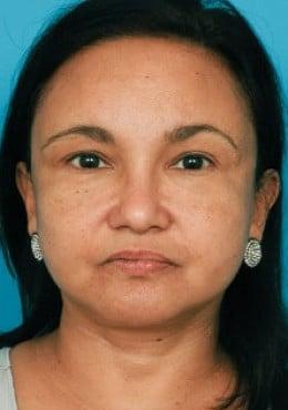 Saltz Plastic Surgery & Saltz Spa Vitoria rhinoplasty after — Salt Lake City, UT