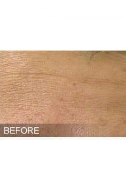 Chemical Peel before at Saltz Plastic Surgery & Saltz Spa Vitoria in Salt Lake City, UT