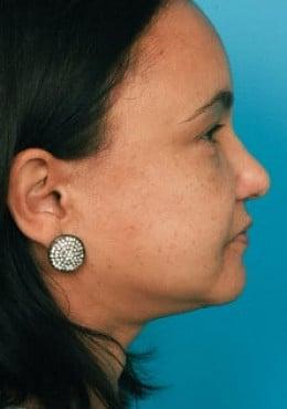 Saltz Plastic Surgery & Saltz Spa Vitoria rhinoplasty after — Salt Lake City, UT