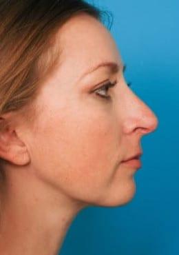 Saltz Plastic Surgery & Saltz Spa Vitoria rhinoplasty after — Salt Lake City, UT