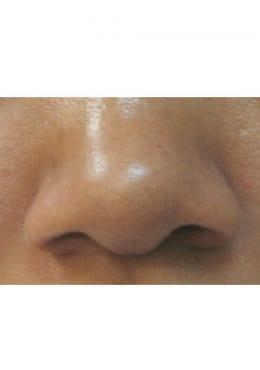 Chemical Peel after at Saltz Plastic Surgery & Saltz Spa Vitoria in Salt Lake City, UT