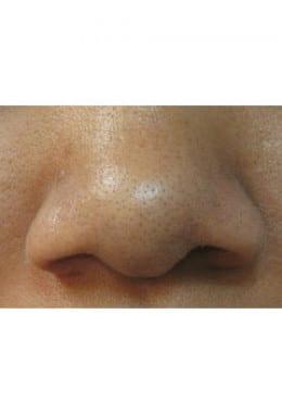 Chemical Peel before at Saltz Plastic Surgery & Saltz Spa Vitoria in Salt Lake City, UT