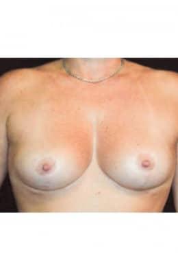 Saltz Plastic Surgery & Saltz Spa Vitoria breast lift after — Salt Lake City, UT