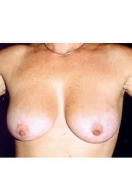 Breast Lift before at Saltz Plastic Surgery & Saltz Spa Vitoria in Salt Lake City, UT