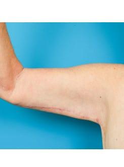Arm Lift after at Saltz Plastic Surgery & Saltz Spa Vitoria in Salt Lake City, UT