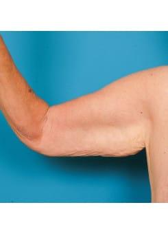 Arm Lift before at Saltz Plastic Surgery & Saltz Spa Vitoria in Salt Lake City, UT