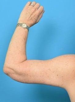 Arm Lift after at Saltz Plastic Surgery & Saltz Spa Vitoria in Salt Lake City, UT