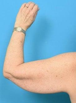 Arm Lift before at Saltz Plastic Surgery & Saltz Spa Vitoria in Salt Lake City, UT