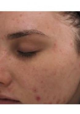 Chemical Peel before at Saltz Plastic Surgery & Saltz Spa Vitoria in Salt Lake City, UT