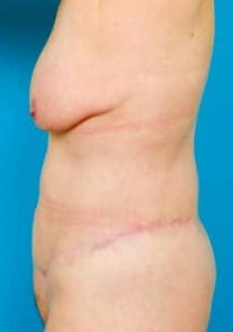 Saltz Plastic Surgery & Saltz Spa Vitoria tummy tuck after — Salt Lake City, UT