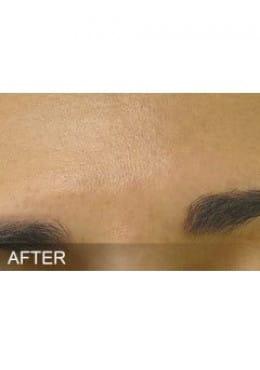 Chemical Peel after at Saltz Plastic Surgery & Saltz Spa Vitoria in Salt Lake City, UT