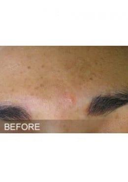 Chemical Peel before at Saltz Plastic Surgery & Saltz Spa Vitoria in Salt Lake City, UT