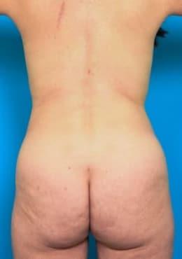 Saltz Plastic Surgery & Saltz Spa Vitoria liposuction after — Salt Lake City, UT