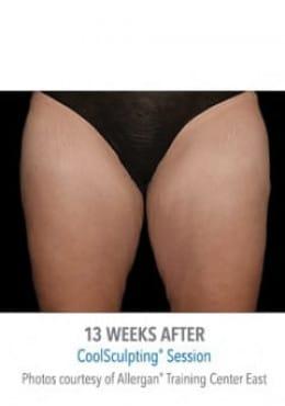 CoolSculpting after at Saltz Plastic Surgery & Saltz Spa Vitoria in Salt Lake City, UT