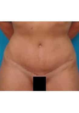 Saltz Plastic Surgery & Saltz Spa Vitoria liposuction after — Salt Lake City, UT