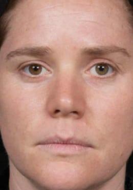 Microneedling after at Saltz Plastic Surgery & Saltz Spa Vitoria in Salt Lake City, UT