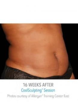CoolSculpting after at Saltz Plastic Surgery & Saltz Spa Vitoria in Salt Lake City, UT