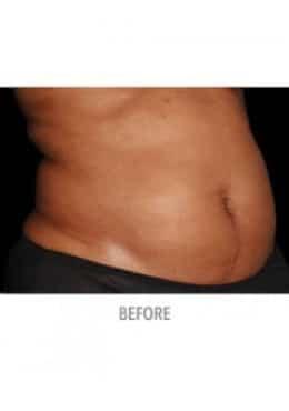 CoolSculpting before at Saltz Plastic Surgery & Saltz Spa Vitoria in Salt Lake City, UT