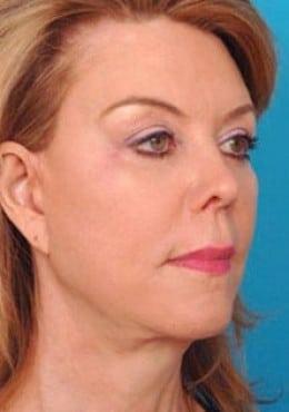 Saltz Plastic Surgery & Saltz Spa Vitoria facelift after — Salt Lake City, UT