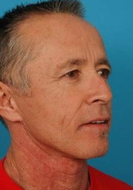Facelift after at Saltz Plastic Surgery & Saltz Spa Vitoria in Salt Lake City, UT