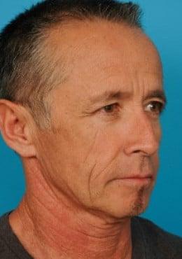 Facelift before at Saltz Plastic Surgery & Saltz Spa Vitoria in Salt Lake City, UT