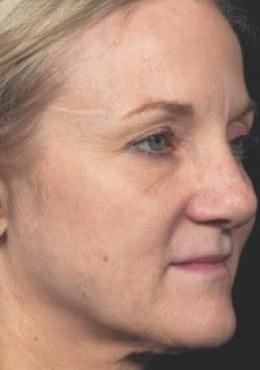 Microneedling before at Saltz Plastic Surgery & Saltz Spa Vitoria in Salt Lake City, UT