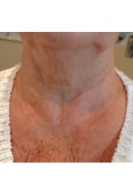 Microneedling before at Saltz Plastic Surgery & Saltz Spa Vitoria in Salt Lake City, UT