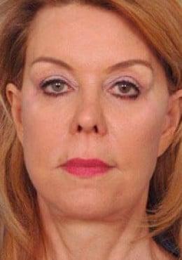 Saltz Plastic Surgery & Saltz Spa Vitoria facelift after — Salt Lake City, UT