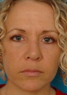 Rhinoplasty after at Saltz Plastic Surgery & Saltz Spa Vitoria in Salt Lake City, UT